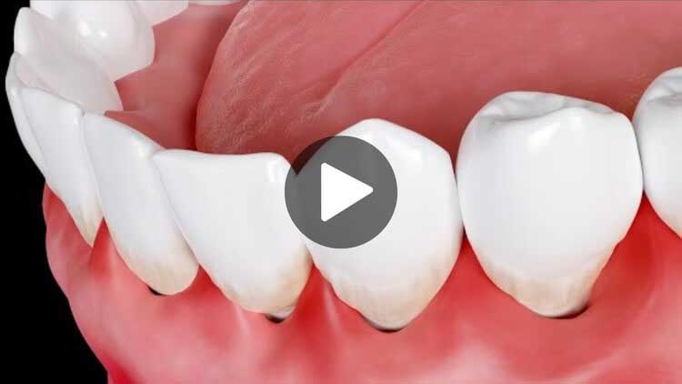 Thumbnail for an educational video on swollen gums